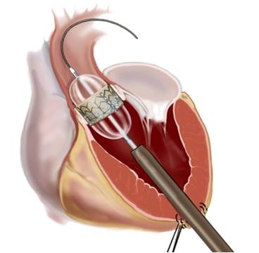 Herz Implantat